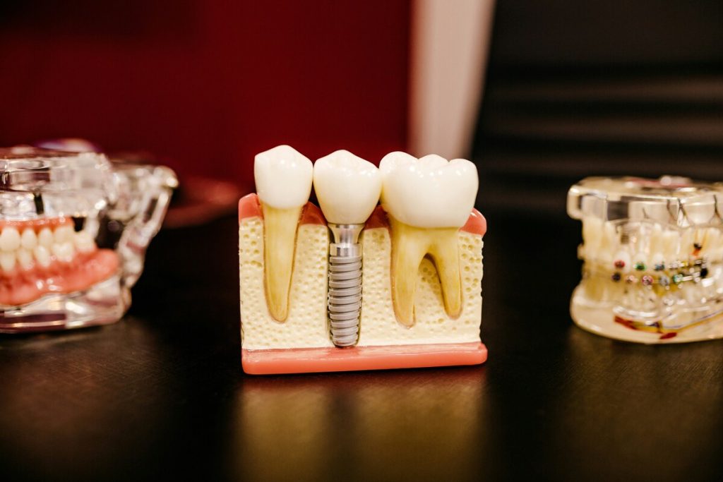 model implantu zębowego na stole